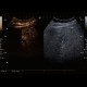 Hemangioma, CEUS: US - Ultrasound